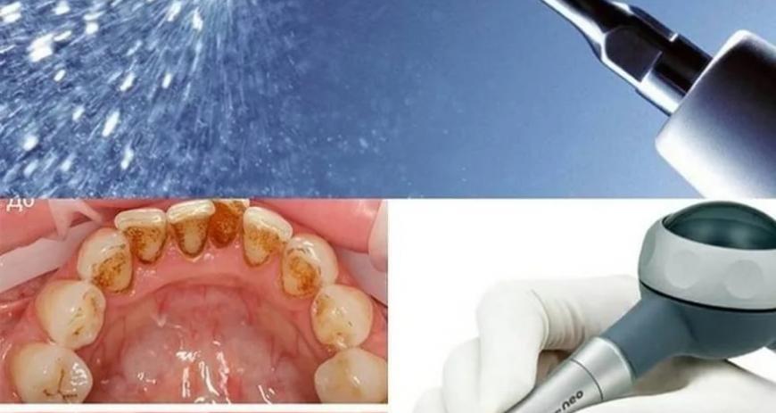 Стоматологическая чистка зубов