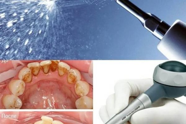 Стоматологическая чистка зубов